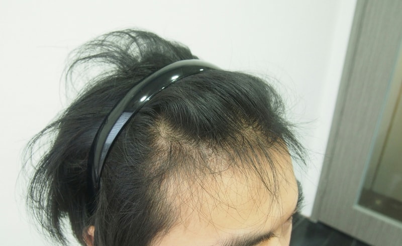 Non-cut partial cut 1100 hair follicles - 4 months later