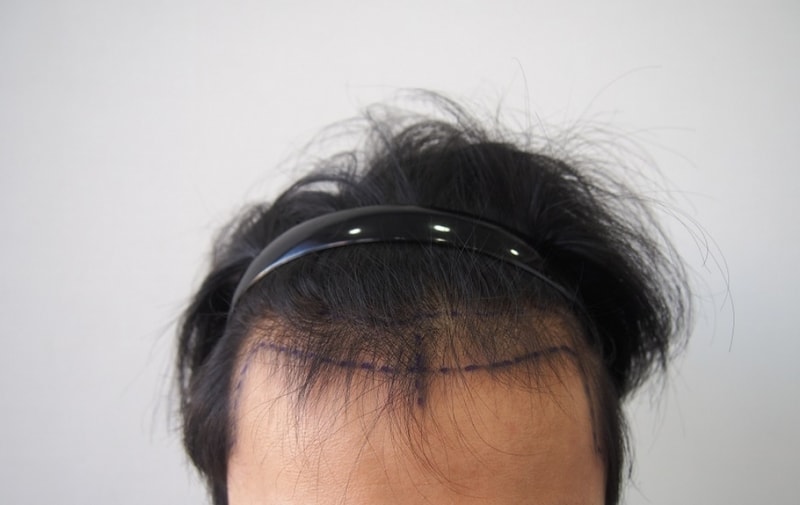 1100 hair follicles with non-cut part - 1 year later