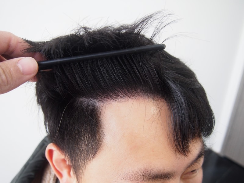 Maternal non-cutaneous 1207 hair follicles 2488 hair 1 year and later