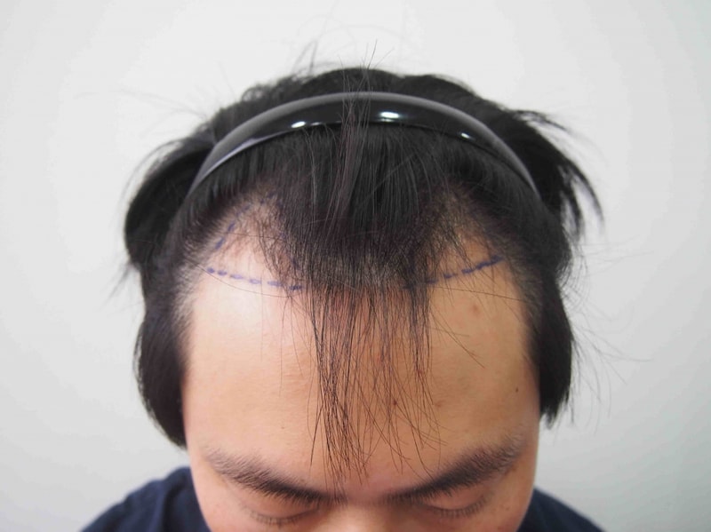 Parental non-cut 1207 hair follicle 2488 hair transplantation review
