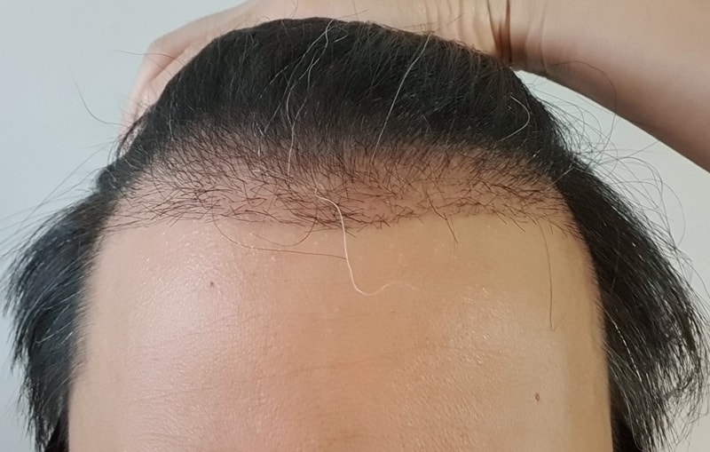 수술 033일차 폭풍 암흑기20220713_140654.jpg