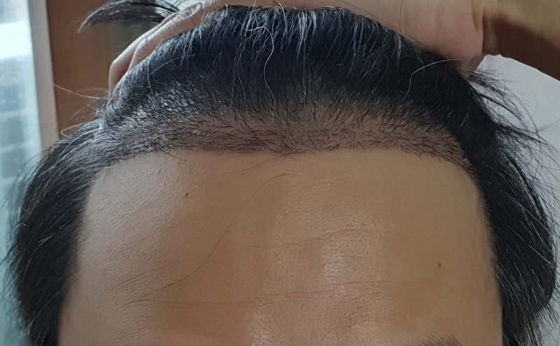 수술 14일차 딱지 후20220628_132148.jpg