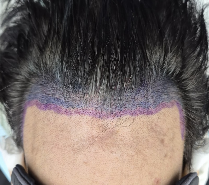 압구정 맘모스 잔머리유지 비절개 모발이식 수술후기