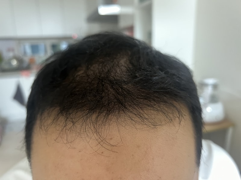 수술후4개월후기