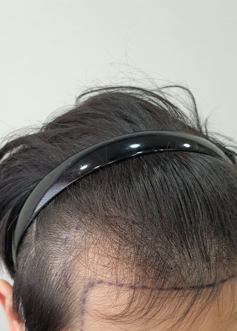 1400 follicles in M-shape incision