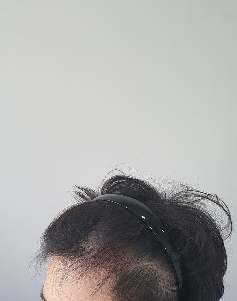 M-shaped incision 1400 hair follicle late stage 4 months