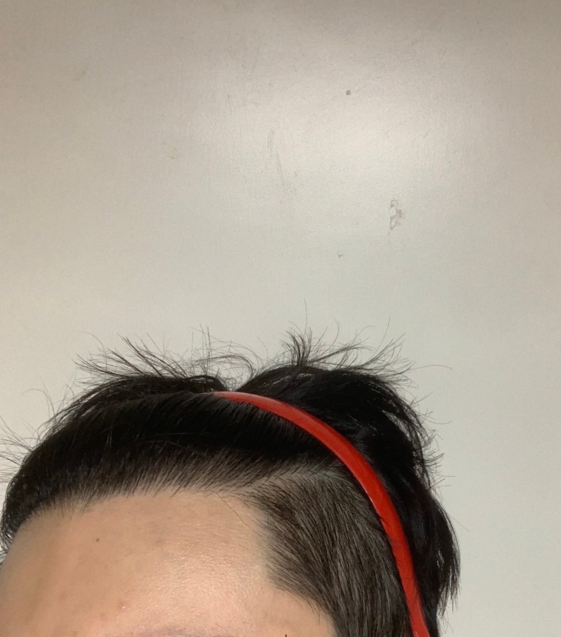 M-shaped incision 1400 hair follicle late 8 months