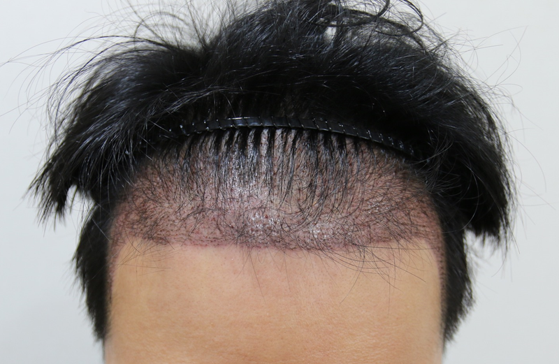 수술 다음날.png