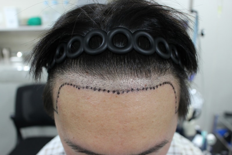 2차 수술 / 모다올의원 양유군 원장님 / 2500모+@ / 비절개