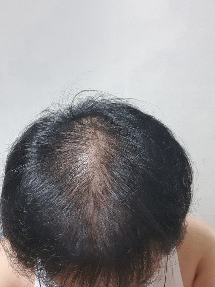 수술후 16주.jpg