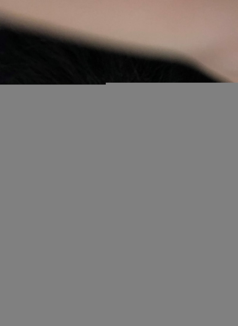 New Hair Clinic Daegu branch's non-cut shaving 1900 hair follicles + α surgery review.