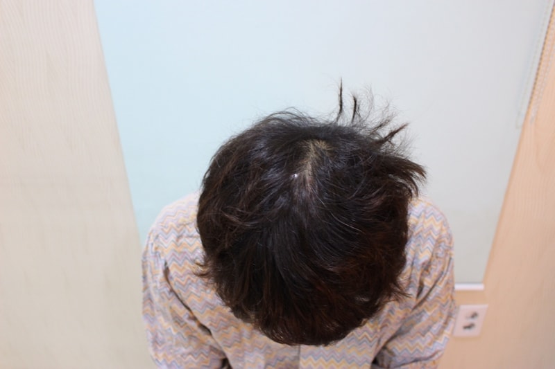 チャームドクター 毛髪移植2500本 3ヶ月目
