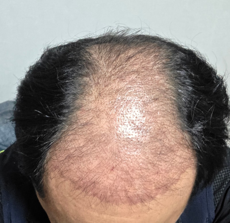 ザ·ブラック大邱植毛5千本