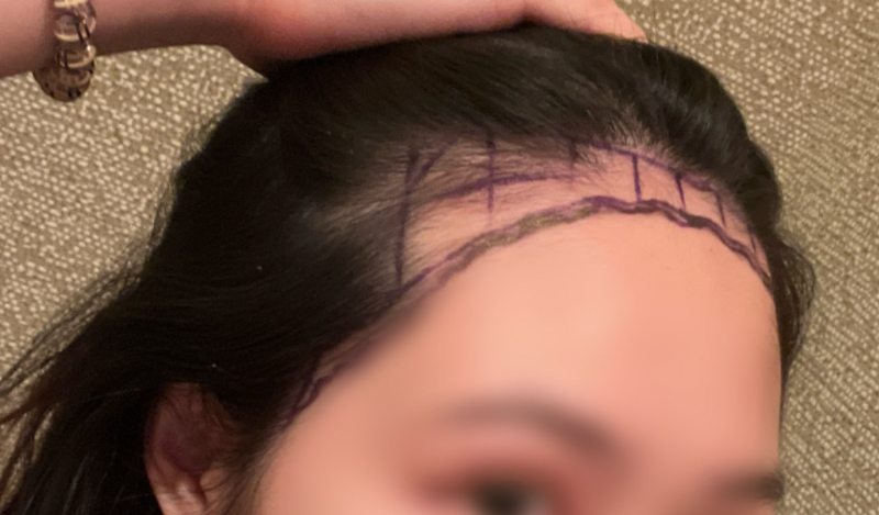 New Hair 1600 Hair follicle incision 6 months later
