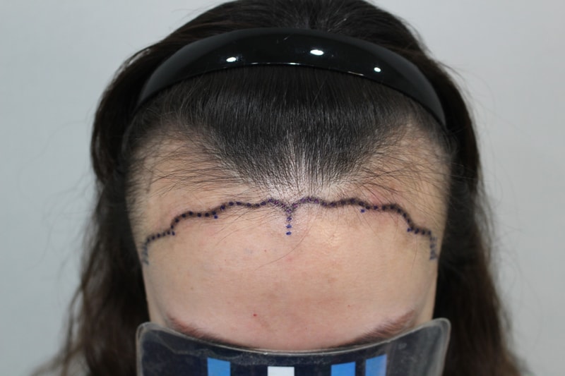 모더함 정한별 원장님 헤어라인+구렛나룻 수술 다음날