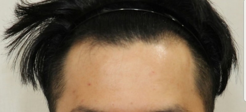 ニューヘア非切開1300毛包197日(約6ヵ月)経過後記です。