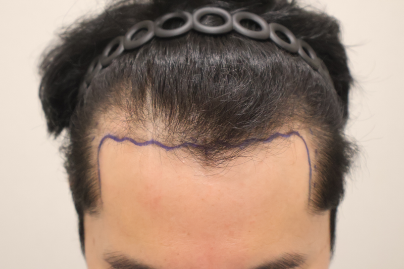 トンタンヘアロ医院 非切開毛髪移植2800本 2週間経過