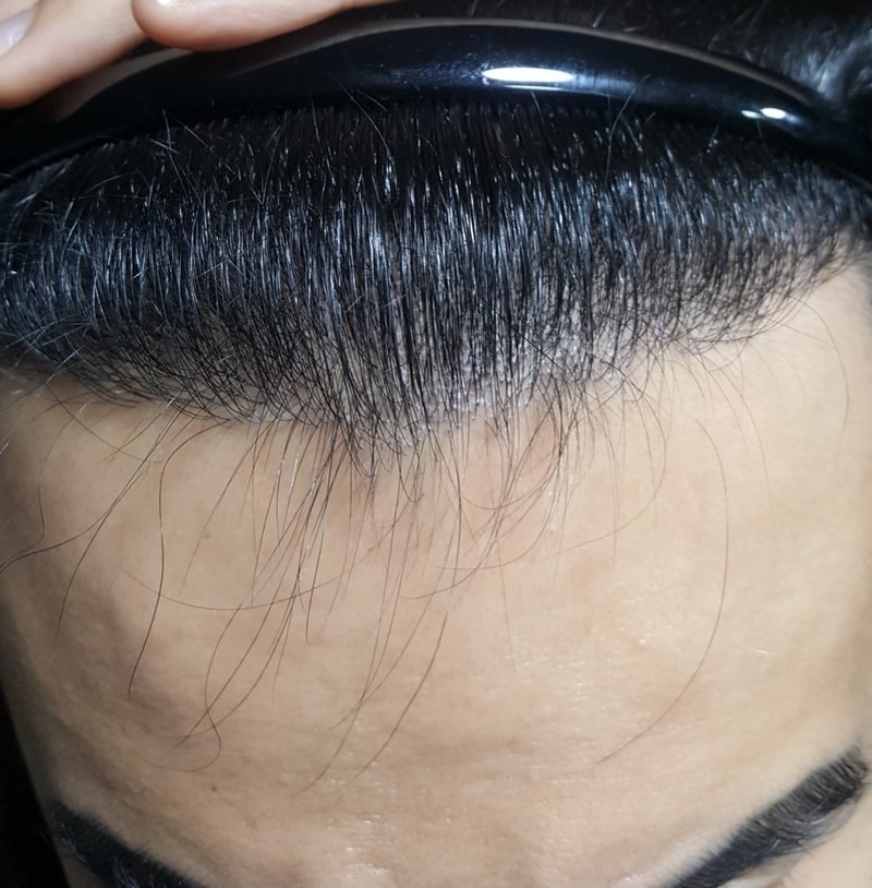 수술후8개월전체2.jpg