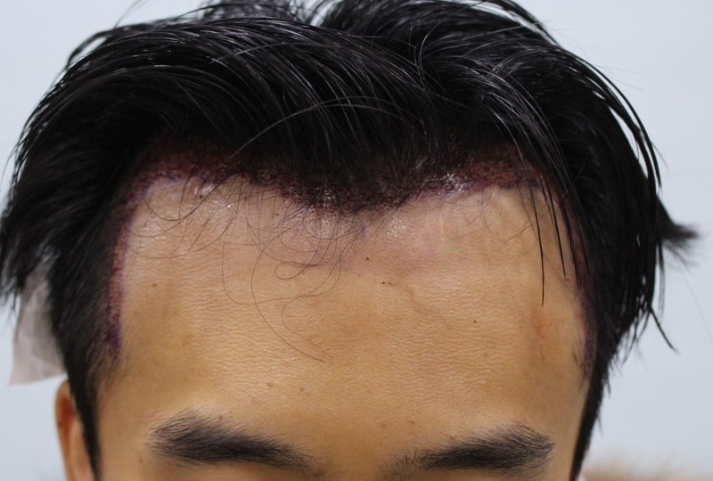 수술직후_r1.jpg