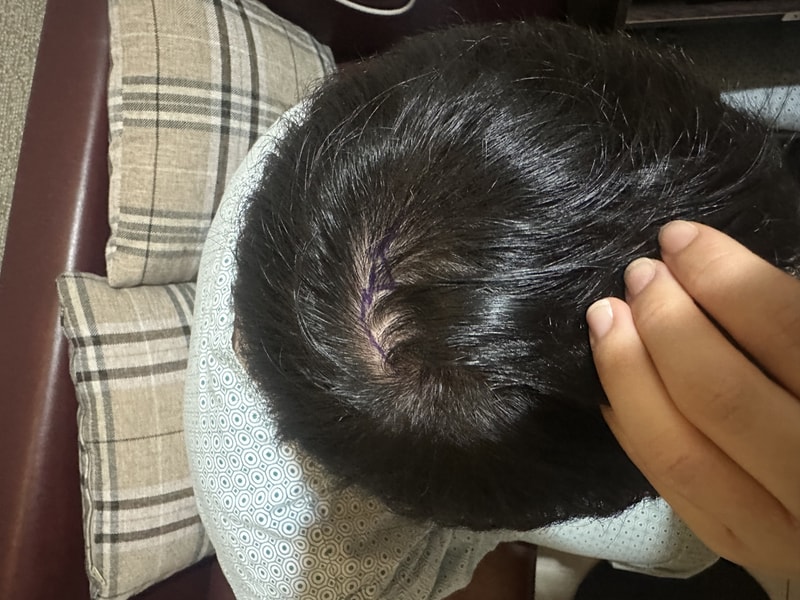 New Hair Day 4 Non-Cutted Hair Transplantation Review / 1200 Hair follicles
