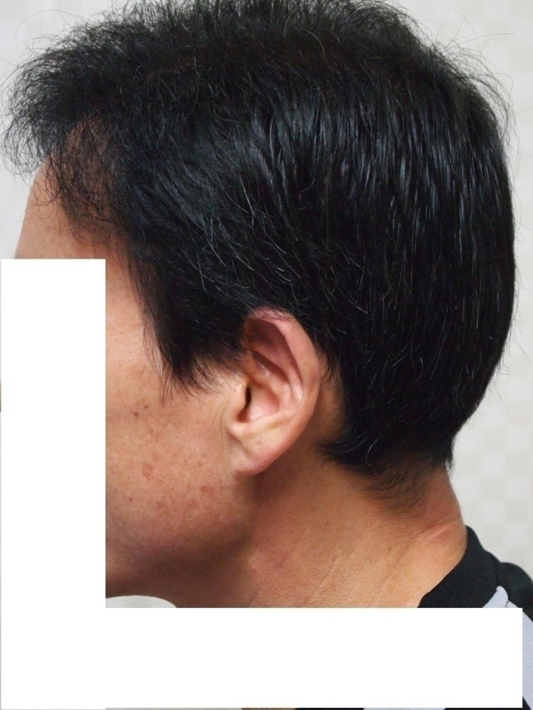 좌측머리.JPG