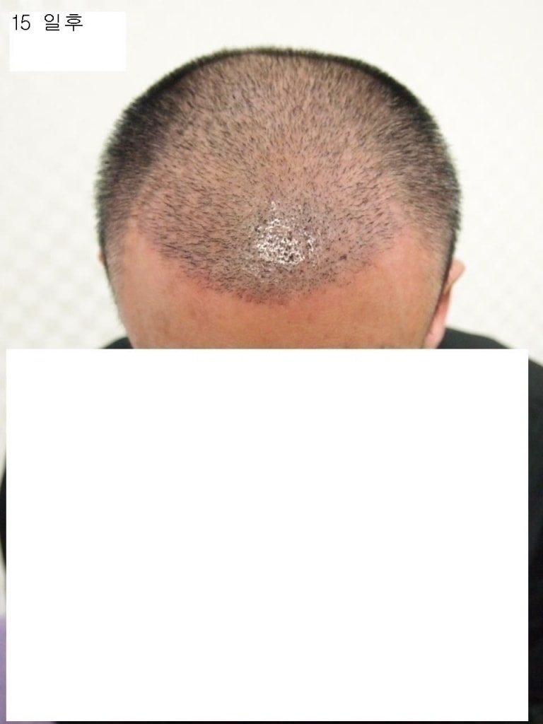 15일후.JPG