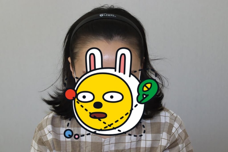 헤어라인 시술 후기입니다!