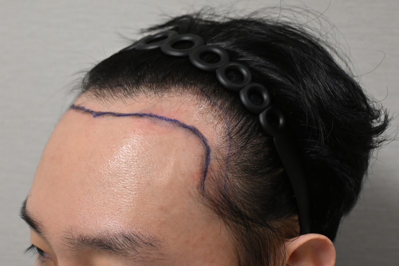 모다올 홍준현 원장님 절개 3700+@ 1일차 후기