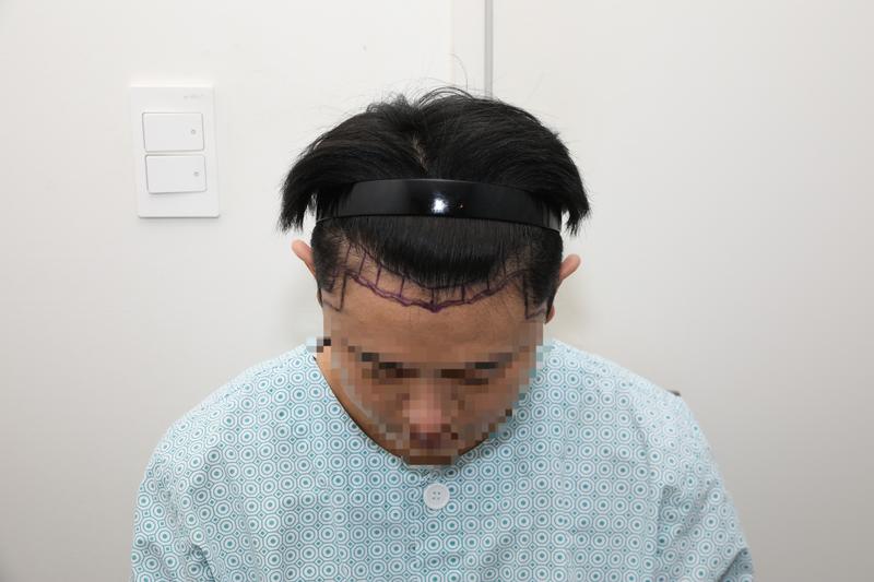 切開 毛髪移植 2000毛包 ヘアライン