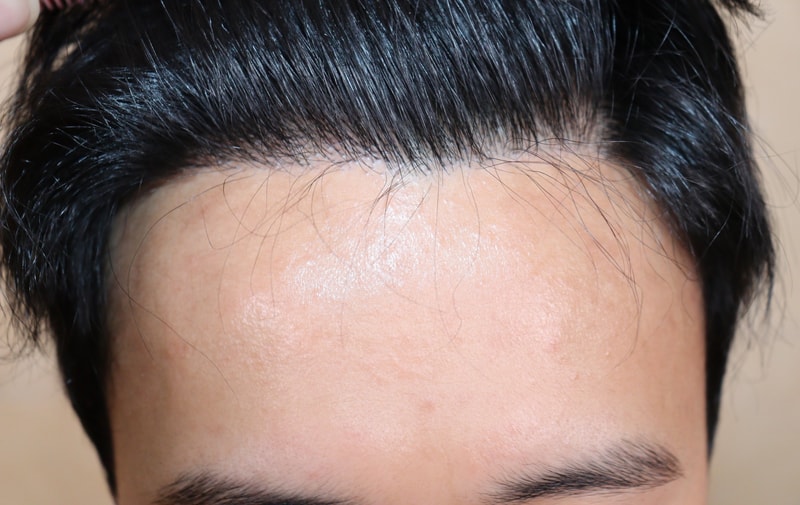 充实3400毛毛发移植后记[8个月]