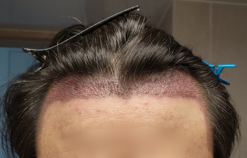 수술13일 지문샴푸후_01.jpg