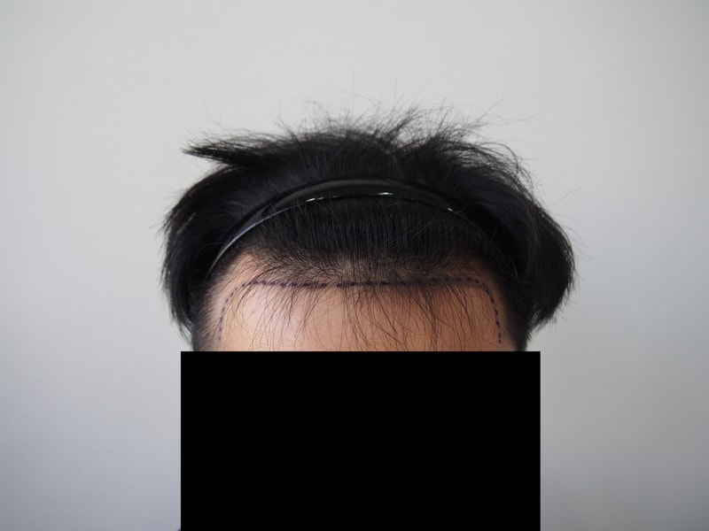 모재성 1800모낭 수술직후 후기