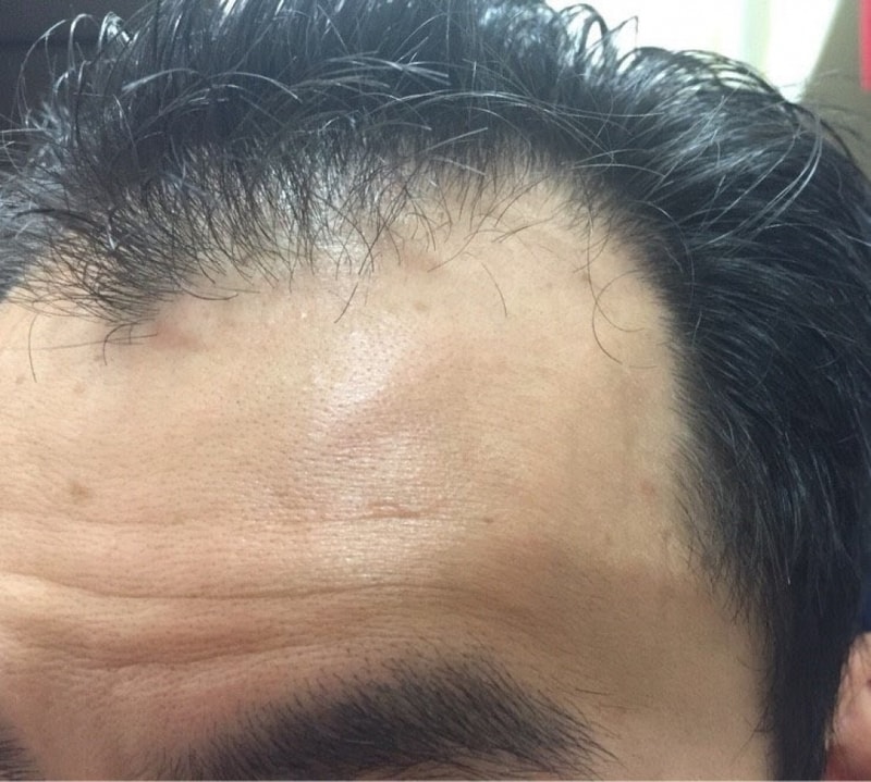 3rd day of non-cut 3000 Mo