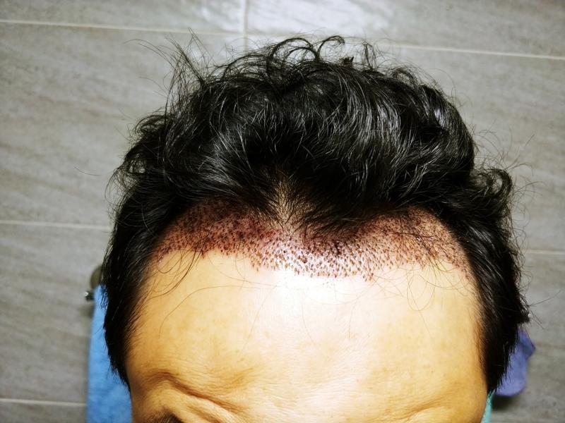 I had 1,200 hair transplants
