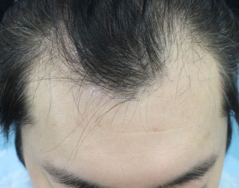 切開3600毛6ヵ月後のレビューです