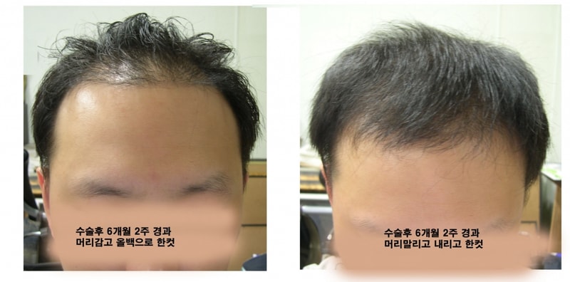 6개월 2주 경과.jpg
