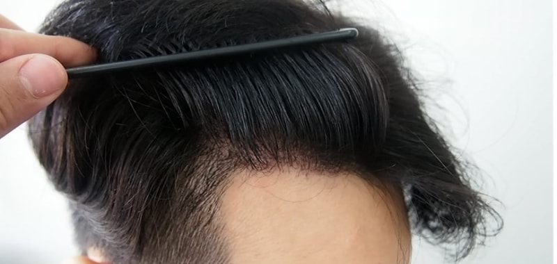It is a year after non-cut 1781 hair follicle 4,633 hair transplantation.