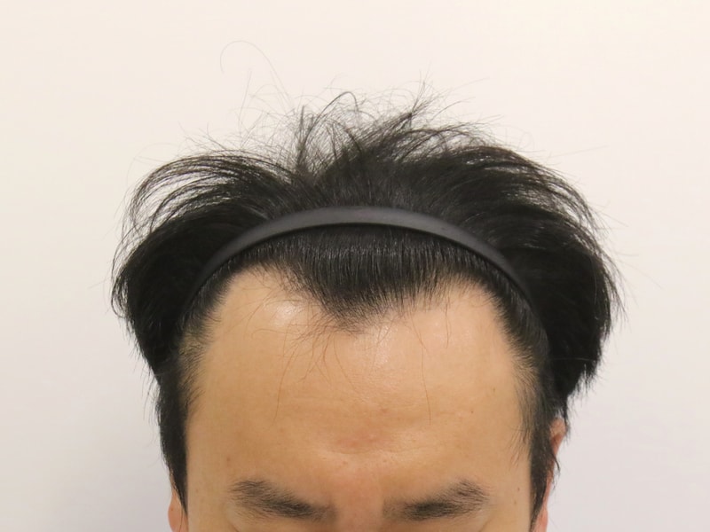 KakaoTalk_20250808_184818487_시술전1.jpg