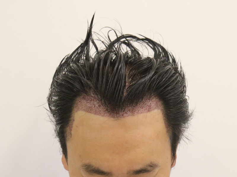 KakaoTalk_20250808_184825109_수술후.jpg