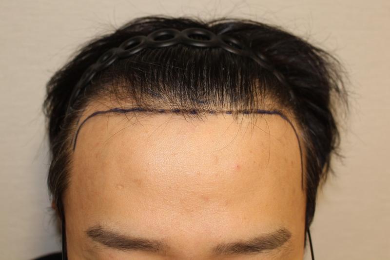 MODALL医院洪准铉院长3200毛接缝移植后记_1
