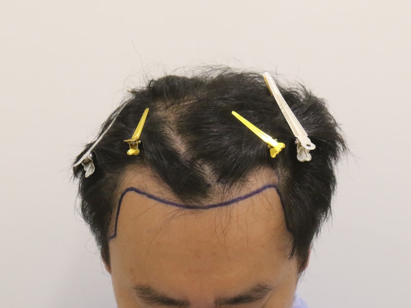 수술 전 디자인.jpg
