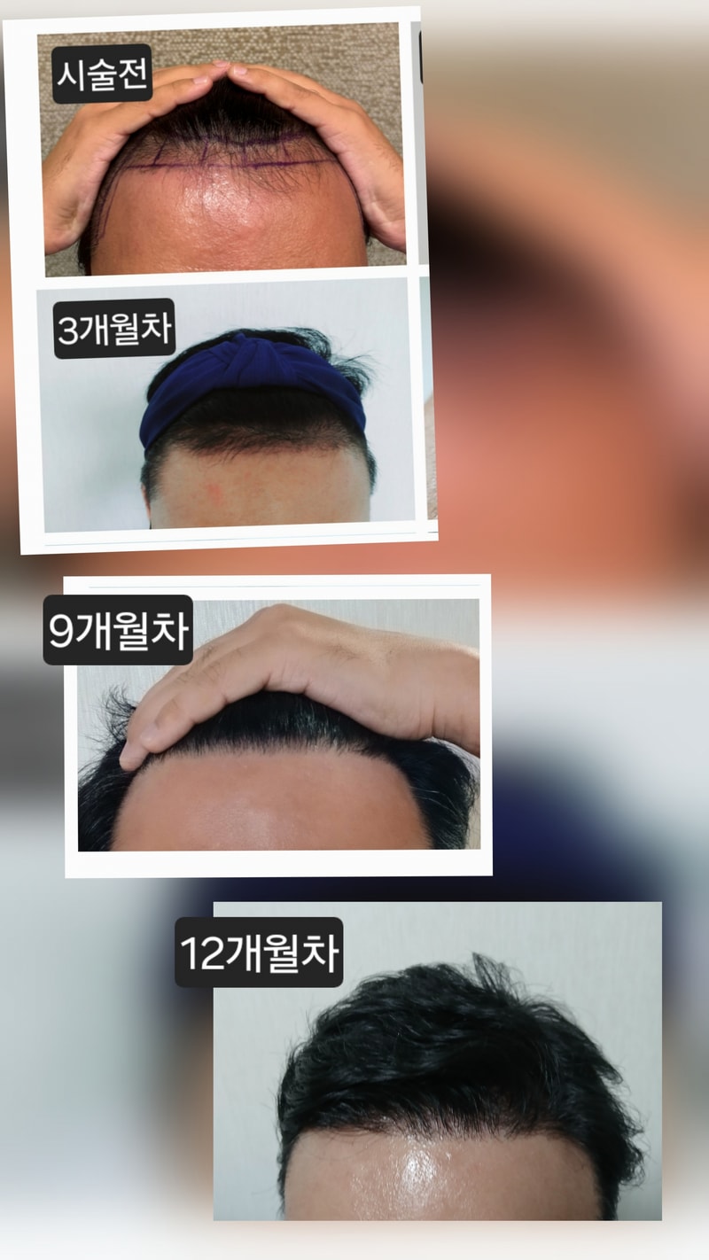 뉴헤어, 모발이식 3400모 12개월차 후기
