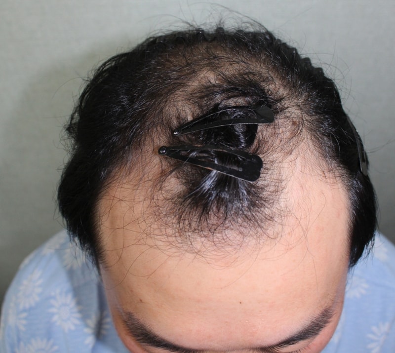 Hannaive / incision / 3882mo / surgery on June 18