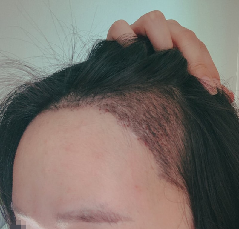 수술1주일차2.jpg