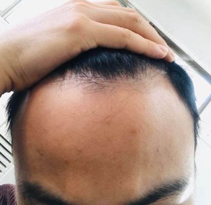 모발이식전입니다..png