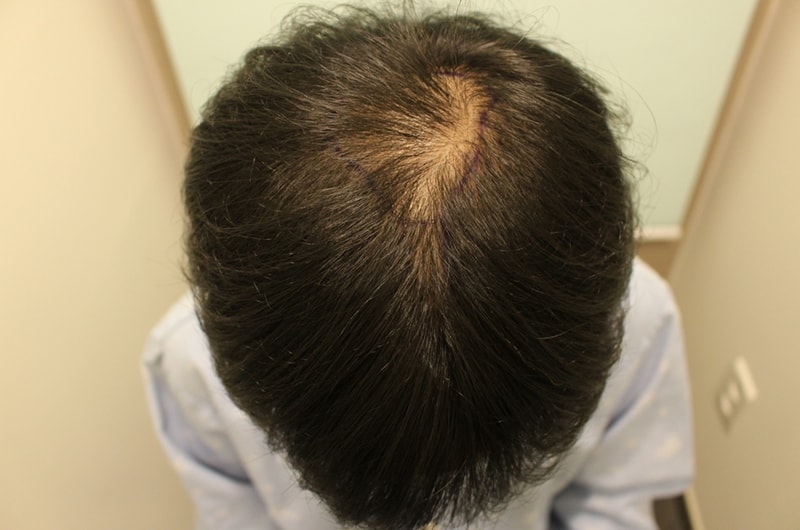 3 years after medication vs. 3 months after hair transplantation