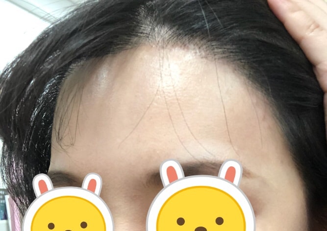 헤어라인2.jpg