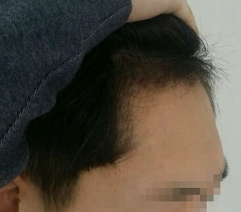 动作）M字及发际线1000毛囊，请进行第3个月的评价