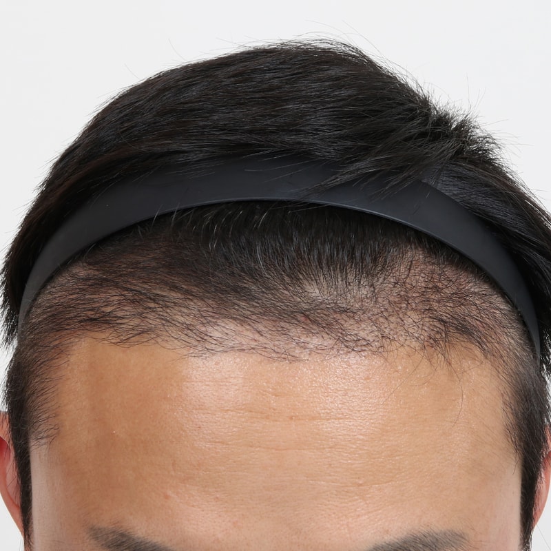 수술 경과 4개월 후.jpg