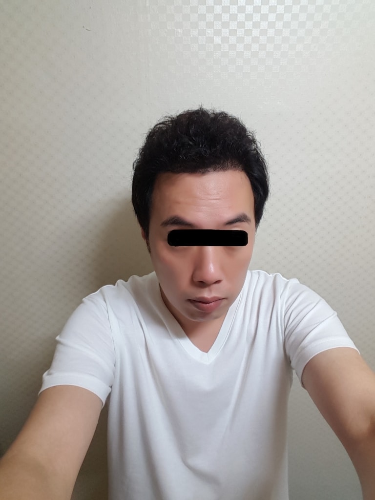 4500모이식후 11개월 및 as1000모받은지 7일째